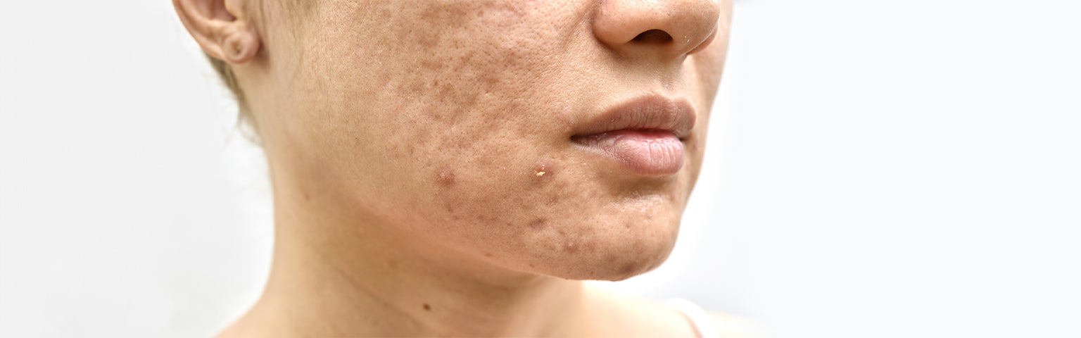 Acne Scars treatment options at Hush Beauty MD