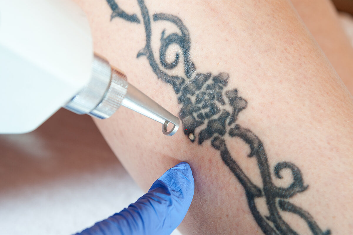 Reclaim Your Identity With Laser Tattoo Removal