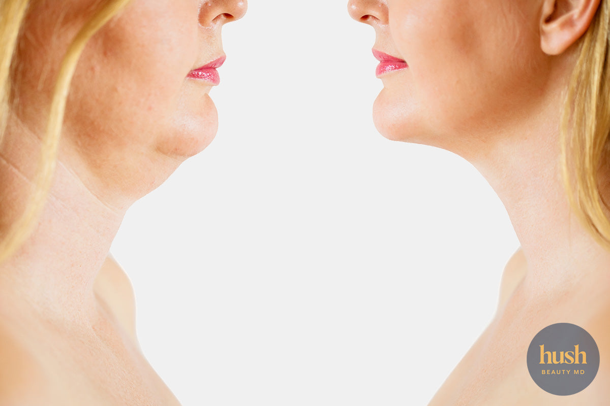 The Secret to Getting Rid of Double Chins:  Introducing Belkyra Treatment