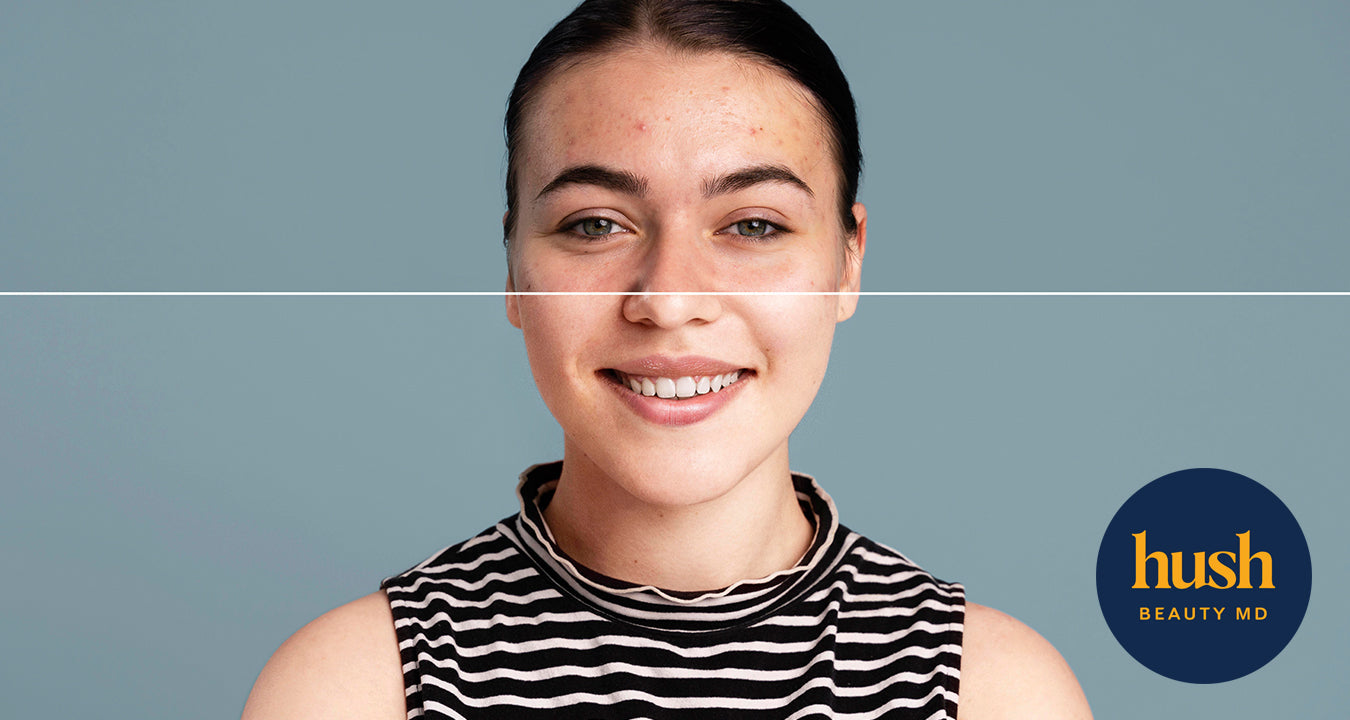 Using Different Options for Acne Scar Treatment