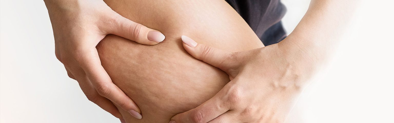 Cellulite treatment options at Hush Beauty MD