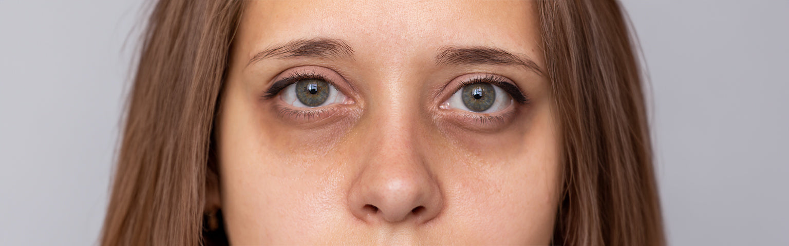 Dark Circles and Hollows treatment options at Hush Beauty MD