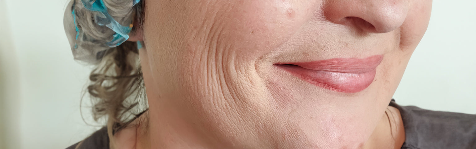Deep Nasolabial Folds (Smile Lines) treatment options at Hush Beauty MD