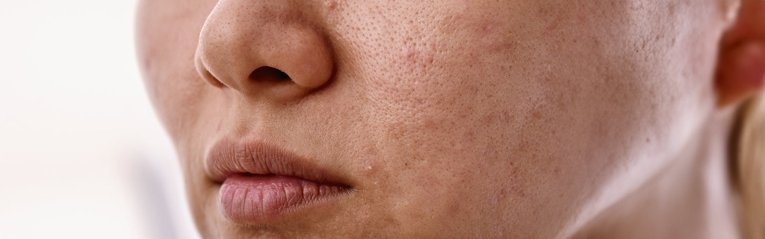 Enlarged Pores Treatment treatment options at Hush Beauty MD