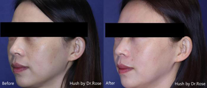 mesotherapy-1