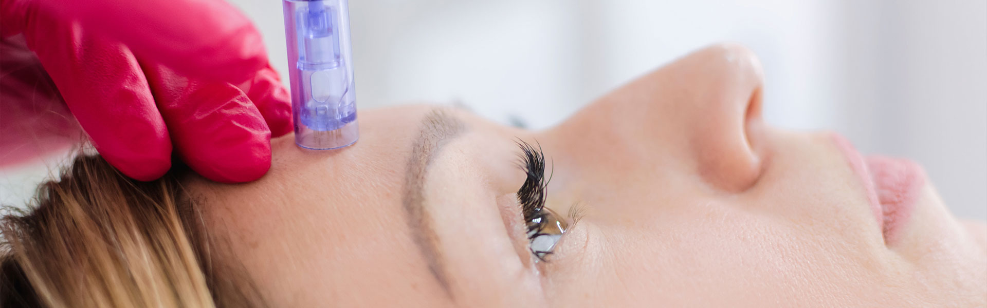 Microneedling treatment at Hush Beauty MD