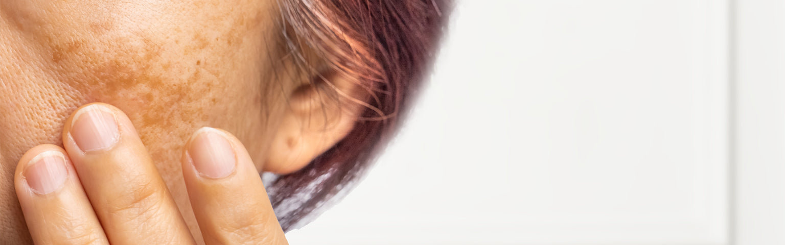 Pigments treatment options at Hush Beauty MD