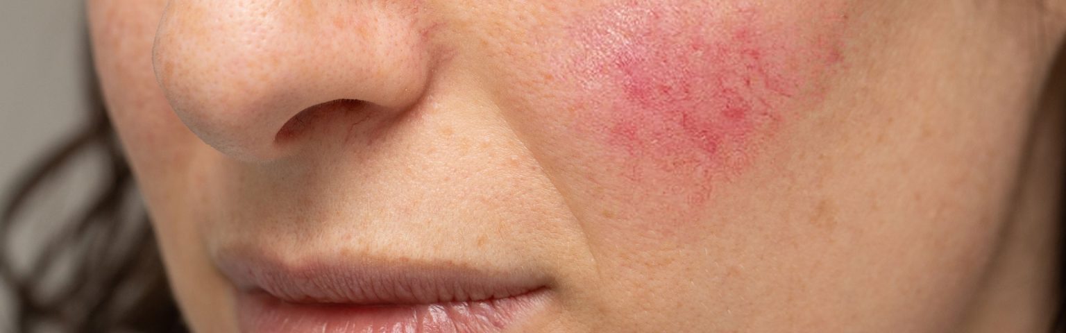 Rosacea treatment options at Hush Beauty MD