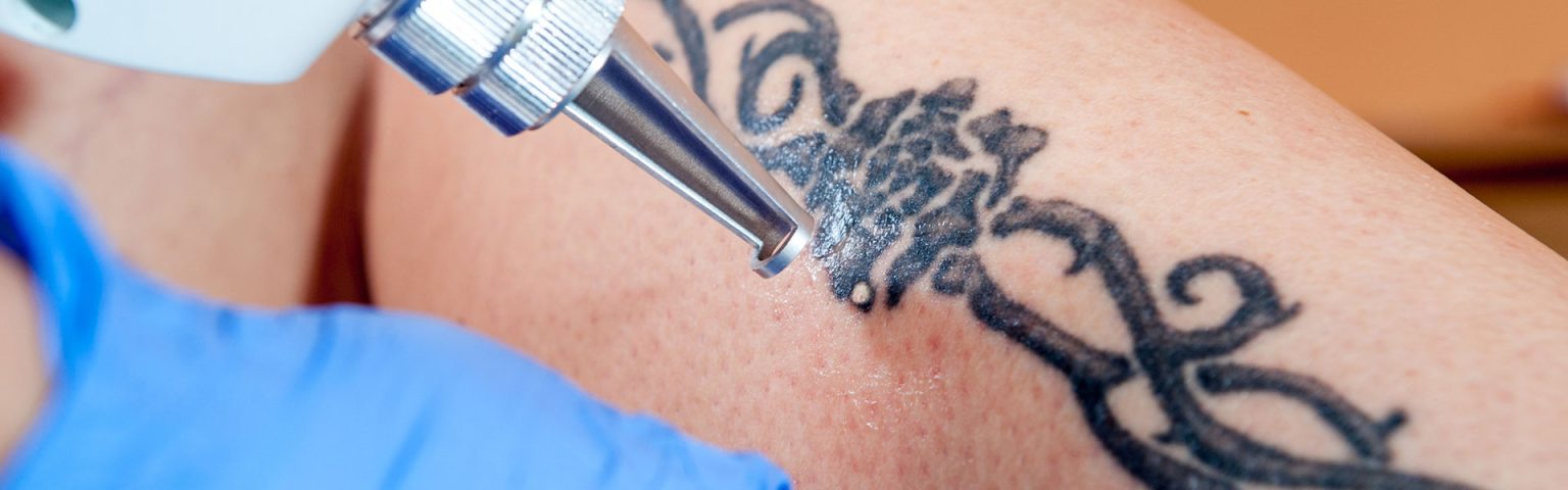 Tattoo Removal treatment at Hush Beauty MD